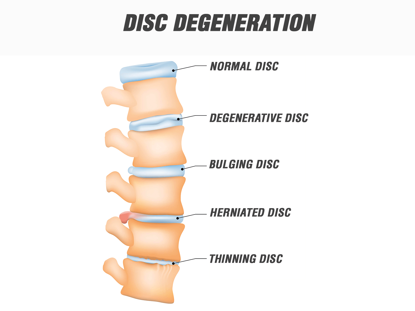 Disco Intervertebral