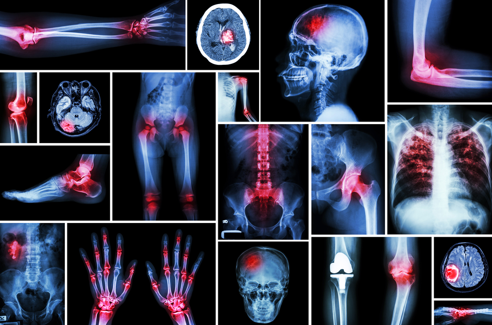 La osteoartritis de cannabis alivia el dolor